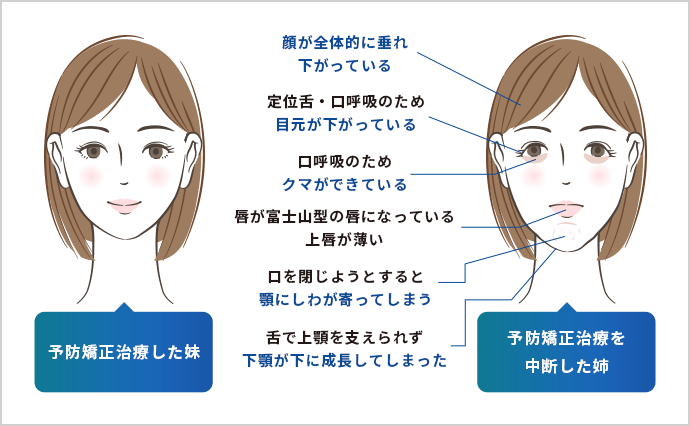 予防矯正治療をした妹、予防矯正治療を中断した姉の比較